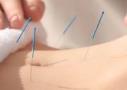 Acupuncture